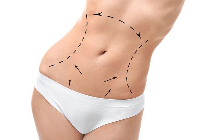 Bauchdeckenstraffung