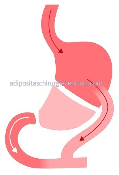 DIE-DUODENAL-SWITCH-OPERATION