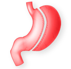 SCHLAUCHMAGEN-OPERATION