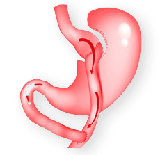 MAGEN-BYPASS-OPERATION