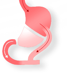 DIE-DUODENAL-SWITCH-OPERATION