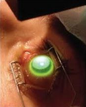 Keretakonus Tedavileri