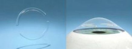 Keretakonus TEdavileri