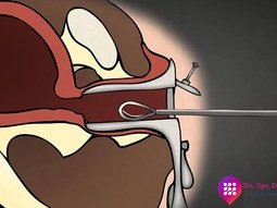 Kürtaj Nasıl Yapılır ?