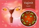 Vajinit Hakkında Her Kadının Bilmesi Gerekenler