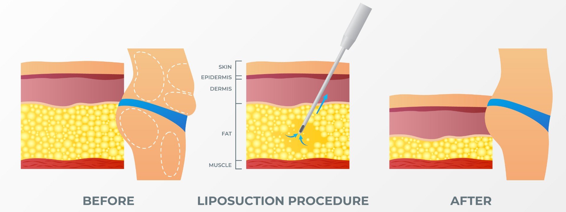 Formedi liposuction surgery