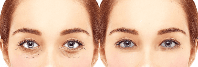 Formedi lower eyelid surgery