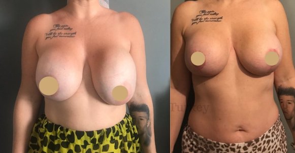 breast implants replacement