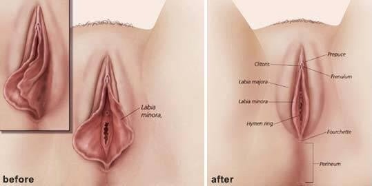Labiaplasty Before After