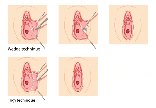 Formedi Labiaplasty Surgery
