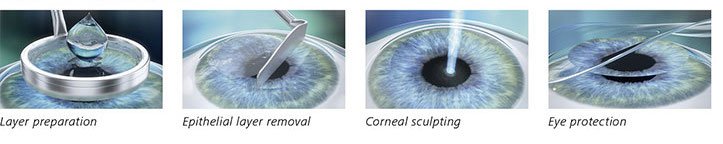 no touch laser eye surgery
