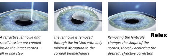 smile relex laser eye surgery