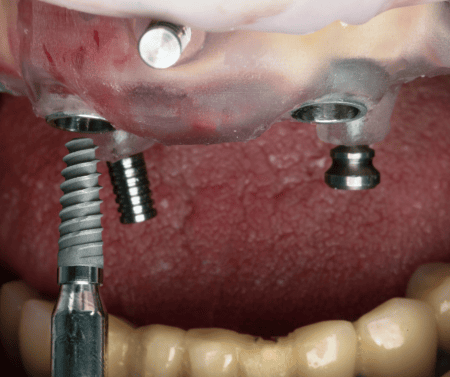 All on 6 implant tedavisi