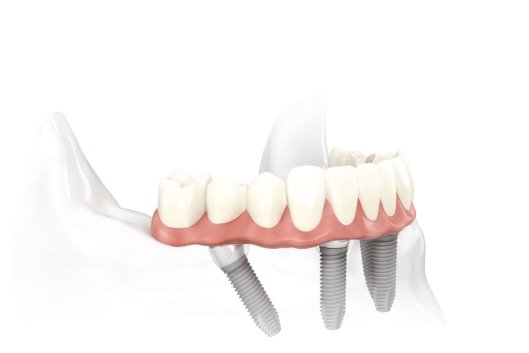 ameliyatsız implant tedavisi