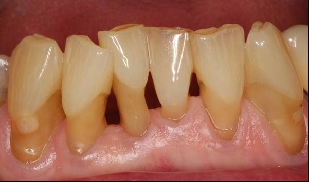 Periodontitis