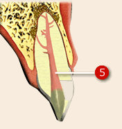 Endodonti 3
