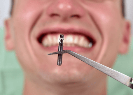 Sigaranın implant tedavisine etkileri