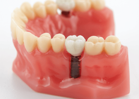 implant Fiyatları 2024
