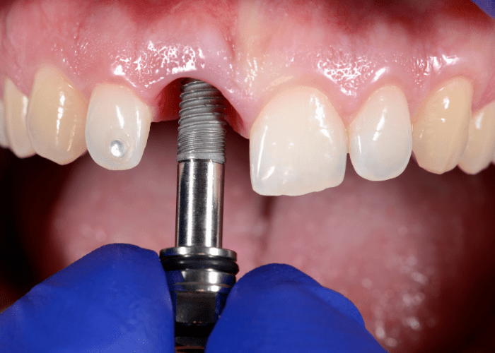 implant fiyatı 2025