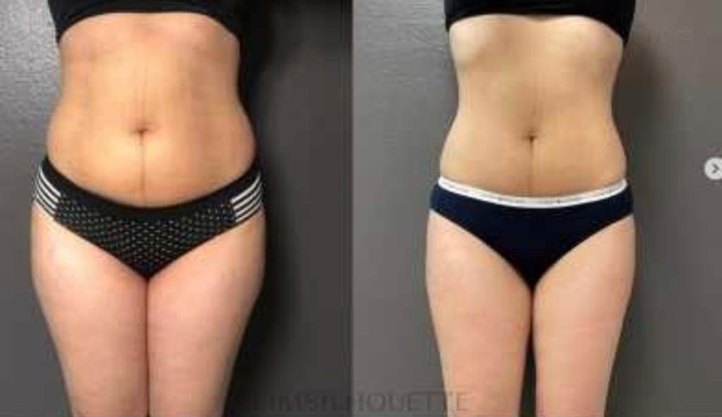 Ems Neo Öncesi Sonrası