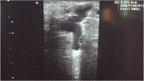 Doppler ultrason perforan ven