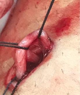 perforan venin cerrahi olarak bağlanması