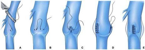 derin venöz yetmezlikte cerrahi