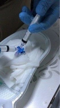 köpük skleroterapi