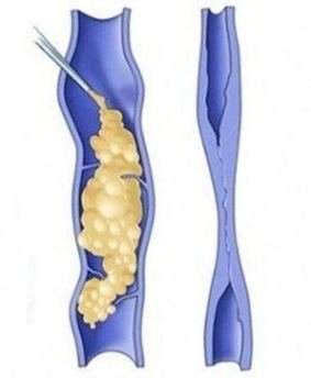 köpük skleroterapi