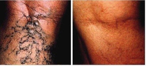 Kılcal varis tedavi öncesi sonrası