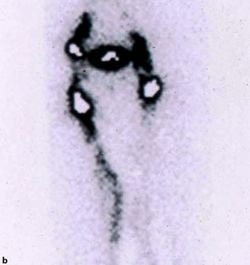 lenfödemde sintigrafi