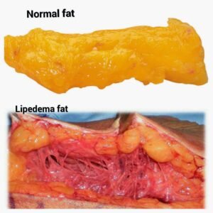 lipedema-fat-300x300