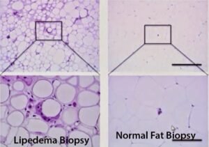 Lipedema.Fat_.Cells_-300x211