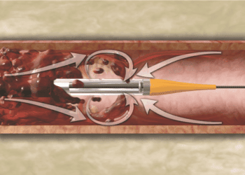 Anjijet mekanik asprasyon sistemi