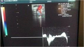 dopplerde perforan ven yetmezliği