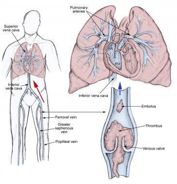 pulmoner emboli
