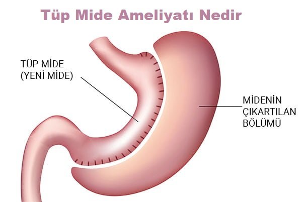 Tüp Mide Ameliyatı Nedir?