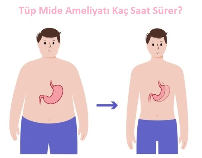 Tüp Mide Ameliyatı Kaç Saat Sürer - 5