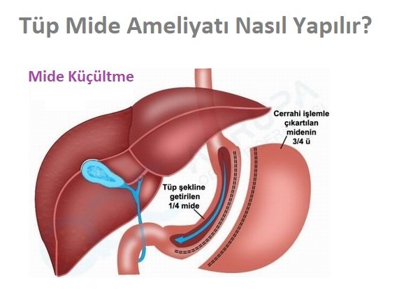 tup_mide_kucultme_ameliyati_nasil_yapilir