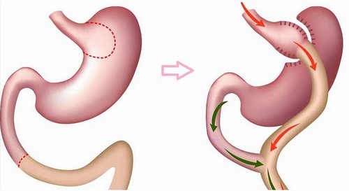 gastrik-bypass