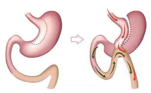mini-gastrik-bypass