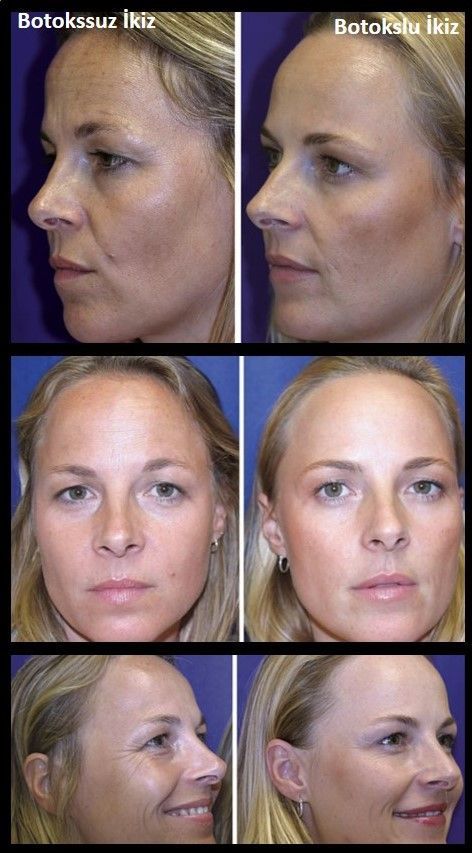 botoks etkisi - 4