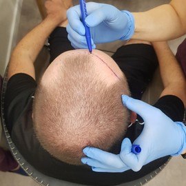 HAARTRANSPLANTATION