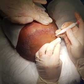 HAARTRANSPLANTATION