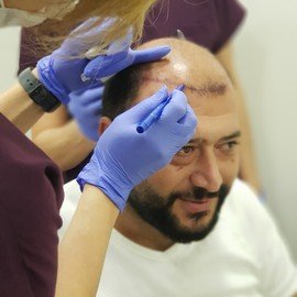 HAARTRANSPLANTATION