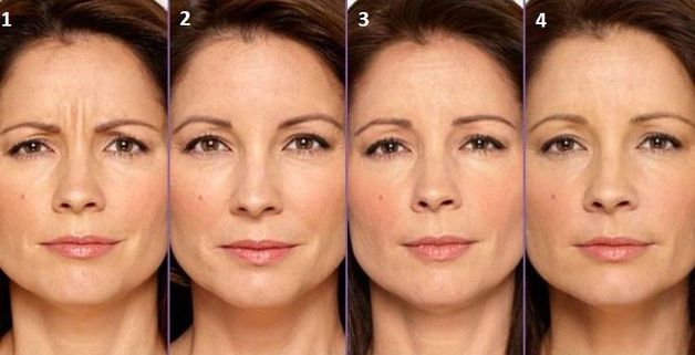 botoks etkisi nasıl biter -11