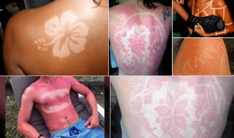 sunburnart