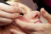 kılcal damar tedavisi 2