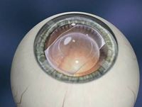 refraktif cerrahiler