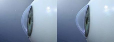 keretakonus Tedavileri